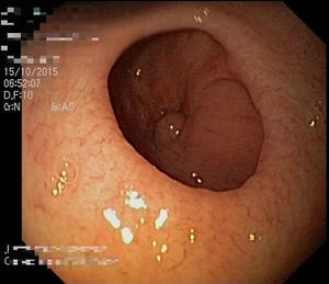 Image of the open pyloric sphincter in which the stenosis of the duodenal bulb is seen.