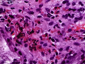 Pathology image of the duodenal bulb mucosa with more than 100 eosinophils per high-power field (HPF).