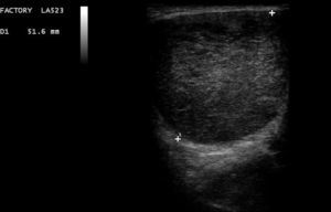 Ultrasound shows a lesion with a heterogeneous appearance.