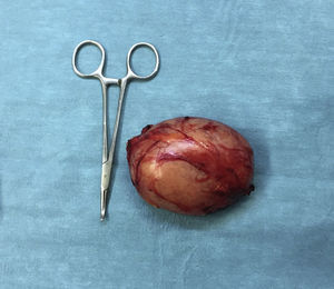 Encapsulated tumour with an elastic consistency.
