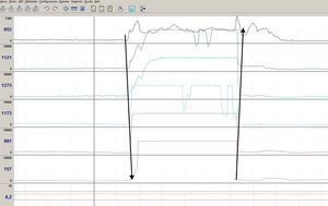 Example of a pH-impedance trace showing a supragastric belch, identified as a rapid rise in impedance (≥1000Ω), moving distally, followed by a return to baseline, moving proximally. Supragastric belches less than 5s apart were considered a single episode.