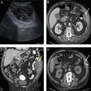 (A) Abdominal ultrasound: abscess 4.2×9.1×10.3cm. (B) Abdominal CT with IV and rectal contrast agents (axial plane): hypodense collection with peripheral enhancement located on the lateral abdominal wall (white arrow). (C) Abdominal CT with IV and rectal contrast agents (sagittal plane): the abscess described in B (white arrow), with no rectal contrast leak. (D) CT-guided radiological drainage of the thickness of the abscess.
