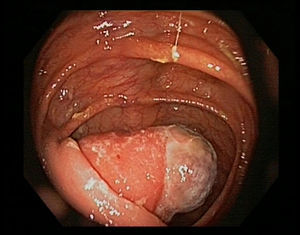 Ileocolic intussusception of ileal lipoma: endoscopic view.