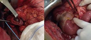 (A) Result after partial duodenectomy. (B) Reconstruction of the intestinal tract via duodenal-jejunal termino-terminal anastomosis and placement of a TachoSil® patch.