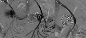 Selective arteriogram: (A) permeability of the PSMA; (B) embolisation of the sac with coils, and (C) placement of the stent.