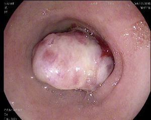 Tumour in the second part of the duodenum, of submucosal appearance, with an irregular and ulcerated surface.