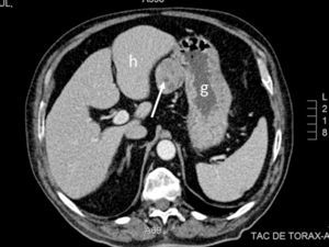 Abdominal CT. Axial section at the level of the upper portion of the abdomen in which a 4cm solid lesion (arrow) located between the liver (h) and stomach (g) can be observed.