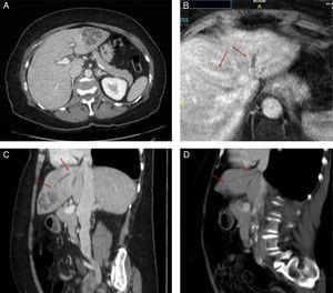 (A) Abdominal CT with diagnosis of liver abscess in segment II/III 5.3×4.8×4.4cm. (B) Abdominal MRI on which thrombophlebitis is identified in the left hepatic vein. With the two arrows the difference in left hepatic vein refill (thrombophlebitis) from the mean (normal) is marked. (C and D) Comparison between the diagnostic abdominal CT (C) and the abdominal CT two months after placement of the percutaneous drainage (D). The arrows indicate the trajectory of the thrombophlebitis in the left hepatic vein in the sagittal section. A marked reduction in the abscess is noted along with persistent thrombophlebitis in the left hepatic vein (arrows). In the follow-up ultrasound at 7 months, full resolution is confirmed.