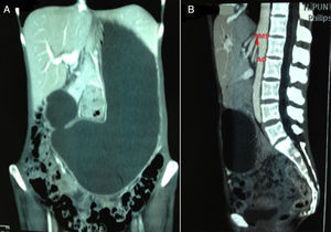 CT images in coronal (A) and sagittal (B) sections, showing massive gastric distension and SMA exiting at an angle less than 25° from the aorta, respectively.