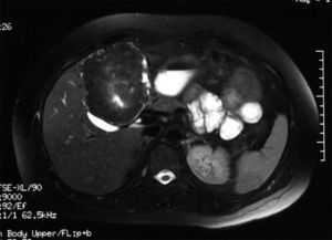 T2-weighted enhanced axial MRI image. Well-defined hypointense lesion with areas of hyperintensity in the IV segment, compressing the gallbladder.