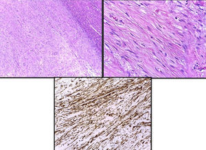 Description from top left to top right to bottom: leiomyoma in relation to the hepatic parenchyma (upper right border). Leiomyoma cells. Immunohistochemical expression of actin in cell proliferation (immunohistochemistry with anti-actin monoclonal antibody×20).