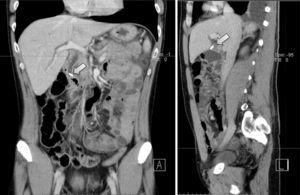 CT scan demonstrating a surgical clip in the common bile duct.