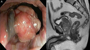 (A) Endoscopic image with a pseudo polyp mameloned tumor with hyperpigmented base and (B) the corresponding image in the magnetic resonance identifying a round hipointense tumor in the rectum.