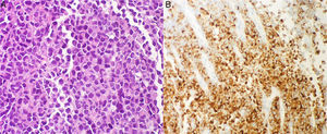 (A) Histology image of the biopsies with medium size epithelioid cells with plasmacytoid habit and (B) the immunophenotype positive to Melan A.