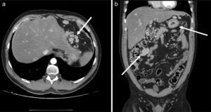 Multiple intraperitoneal nodules of various sizes. Morphologically and size wise they are compatible with splenosis (white arrows).