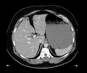 Abdominal CT: large gastric dilatation with intrahepatic portal gas.