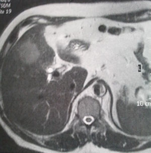 Magnetic resonance. Image suggestive of gallbladder cancer.