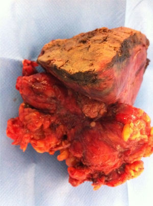 Surgical specimen including gall bladder, fatty tissue and affected liver segment.