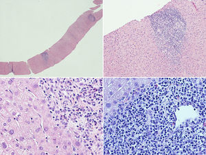Liver histological examination. The liver tissue specimen, with a sufficient number of portal spaces, show a moderate lymphoplasmacytic inflammatory infiltrate with poor eosinophilic component; bile ducts were attacked in several tracts by lymphocytic cells with evidence of interface hepatitis and ductular proliferations. No evidence of significant fibrosis.