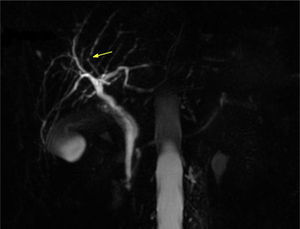 The dominant stricture in magnetic resonance cholangiopancreatography developed during the follow-up period.