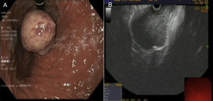 (A) Gastroscopy: pendulous tumour, below the cardia. (B) Endoscopic ultrasound: supracardial, subepithelial lesion, with well-defined margins, located above the diaphragmatic pillars.