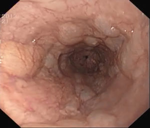 Upper gastrointestinal endoscopy demonstrating multiple mucosal protrusions compatible with pneumatosis of the esophagus.