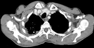 CT scan demonstrating subserosal cysts of air in the middle third of the esophagus.