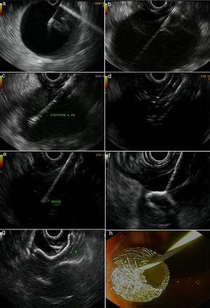 A fluoroless case, with images showing endosonography (EUS)-guided transgastric drainage of a pancreatic fluid collection (PFC) with a lumen-apposing metal stent (LAMS). (a) Puncture of a PFC using a 19-gauge fine needle (Expect Flex, Boston Sc); (b) EUS image showing the 0.035-inch guidewire advancing through the 19-gauge needle into the collection; (c) 6 Fr-cystotom inside the PFC; (d) EUS dilation of the transmural tract using a biliary balloon; (e) AXIOS catheter inserted into the PFC; (f) the distal flange of the LAMS (10×10-mm, AXIOS) inside the PFC; (g) AXIOS stent completely delivered; (h) endoscopic view of the AXIOS stent.