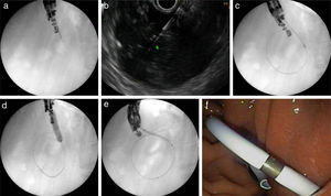 A fluoroscopy guidance case. Sequence of fluoroscopic and endosonography images showing transgastric drainage of a pancreatic fluid collection (PFC) with a double pigtail stent (DPS); (a) puncture of the collection using a 19G needle; (b) insertion of a guide-wire into the lesion; (c) fluoroscopy view of a 6Fr-cystotome over a guidewire; (d) radiological image of the transmural tract dilation with a biliary balloon of 8mm; (e) insertion of the DPS using fluoroscopic guidance; (f) endoscopic image of the DPS.