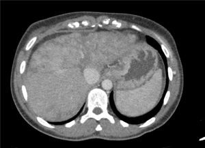 CT scan of the abdomen and pelvis with contrast dye on 30/07/2015: diffuse parenchymal liver disease, predominantly in the left lobe of the liver, with a heterogeneous mosaic pattern of signal intensity with permeable hepatic veins. It also shows areas of capsular retraction and changes in hepatic contour.