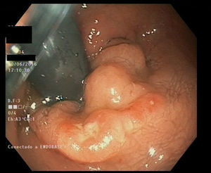 Endoscopic image of lesion in the rectum.