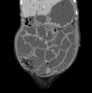 CT scan of the abdomen and pelvis with IV contrast dye. Mesenteric and retroperitoneal lymphadenopathy.