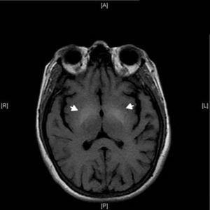 Axial T1-weighted brain magnetic resonance imaging. Symmetrical hyperintensities in lentiform nuclei (arrows).