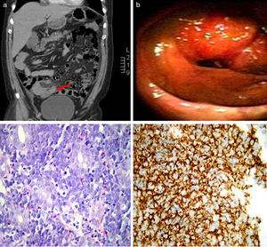 Intestinal Burkitt lymphoma. (a) Axial Computed Tomography cut, with a regular parietal thickening of the terminal ileum that protrudes the cecal base through the valve. (b) Colonoscopy exam showed a 4cm pseudopolyploid ileal lesion that protruded through ileocecal valve. (c) H & E original magnification 400×. A diffuse proliferation of neoplastic cells is observed from medium to large size, among which macrophages can be found, resulting in “starry-sky” pattern characteristic of Burkitt lymphoma. (d) Positive staining for CD 20 in immunohistochemistry.