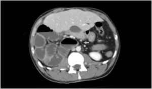 Axial CT-scan showing malposition of the large bowel and small intestine and abnormalities in the disposition of vascular structures (arrow).