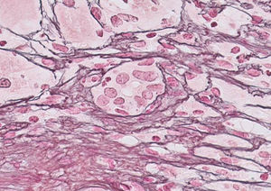 Liver biopsy: rosette formation. Haematoxylin–eosin staining at 40× magnification.