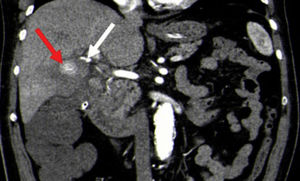 White arrow: pseudoaneurysm. Red arrow: gallstone.