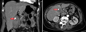 The arrow is indicating the arterial pseudoaneurysm.