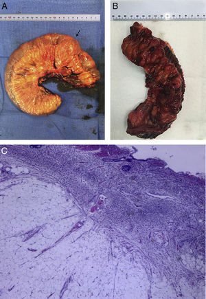 (A) Middle segment of the ileum with occasional protruding serosal nodules. (B) Open segment of ileum with multiple superimposed mucosal nodule formations. (C) Fibromatous cell proliferation in ileum mucosa with exaggerated growth of submucosal adipose tissue.