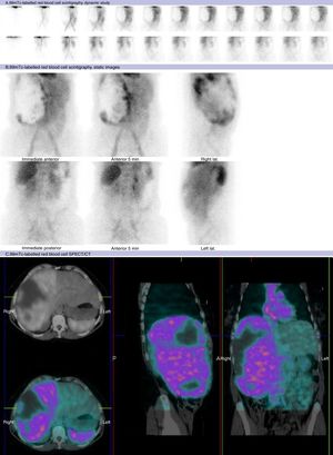 99mTc-labelled autologous red blood cell scintigraphy (A: dynamic study, B: static images, C: late images, D: fused SPECT/CT images), showing a marked increase in metabolism in RL (C) in relation to haemangioma, with respect to the rest of the liver which has homogeneous uptake. Within the haemangioma, areas of complete absence of uptake can be seen, probably related to infarcts or necrotic areas within the lesion.