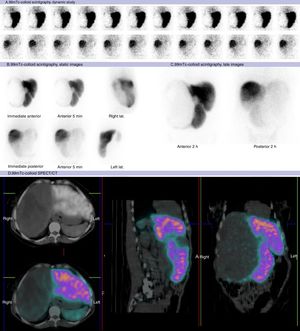 99mTc-phytate scintigraphy (A: dynamic study, B: static images, C: fused SPECT/CT images) corroborates the nature of the lesion due to the complete absence of metabolism with higher density areas within it corresponding to infarcts, as seen in SPECT/CT (D).