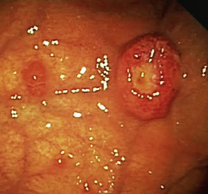 Endoscopic lesions at the gastric fundus.
