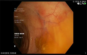Colonoscopy: patchy distribution of erythematous areas in the left colon.