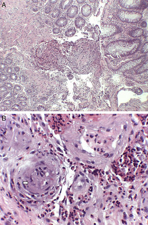 Histological findings (haematoxylin and eosin staining): (A) submucosa with predominantly eosinophilic inflammatory infiltrate with perivascular distribution and marked thickening of the vascular walls (H&E ×40). (B) At higher magnification, the permeation of vascular walls by the infiltrate is highlighted, with occlusion of some vascular lumens (arrow) (H&E ×200).