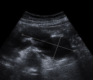 Abdominal ultrasound: presence of a multicystic image in the tail of the pancreas.