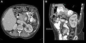 Axial (A) and parasagittal (B) view of abdominal CT: subcostal hernia before repair.
