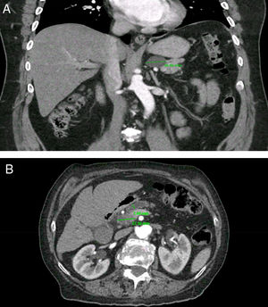 Clinically important pancreatic cysts (CIPCs). A) CIPCs based on Fukuoka guideline: Pancreatic cyst larger than 30mm in the body/tail of the pancreas. B) CIPCs based on AGA guideline: Pancreatic cyst smaller than 30mm in the neck of the pancreas with a solid component and pancreatic duct dilation.