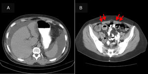 Computed tomography (CT) scan of the abdomen. (A) Moderate amount of ascites in perihepatic spaces, perisplenic spaces, paracolic gutters and pelvis. Homogeneous liver with regular borders. (B) Rarefaction of mesenteric fat suggestive of mesenteric oedema (arrows).