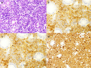 (a) Haematoxylin and eosin staining showing lymphoid infiltrate with a starry-sky pattern; (b) immunohistochemistry positive for CD20 (B-cell marker); (c) immunohistochemistry positive for CD10 (typical of BL); and (d) Ki-67 with a rate of proliferation close to 100%.