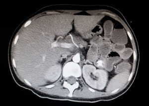 Distension of small bowel loops with intraluminal extravasation of intravenous contrast in the proximal jejunum, consistent with active arterial bleeding on computed tomography angiography of the abdomen.